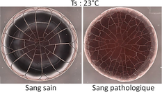 Morphologie des dépôts lors de l’évaporation de gouttes de sang sain et pathologique